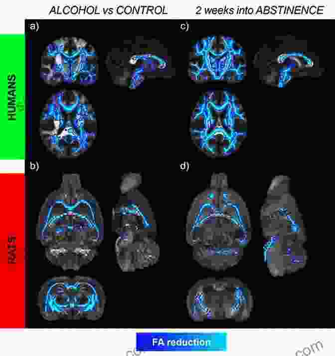 Brain Scan Showing Changes In Brain Function In Individuals With Alcoholism Heavy Drinking: The Myth Of Alcoholism As A Disease