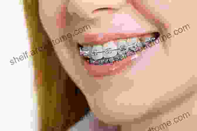 Traditional Metal Braces Brace Yourself: The Ultimate Guide To Braces Invisalign And A Beautful Smile